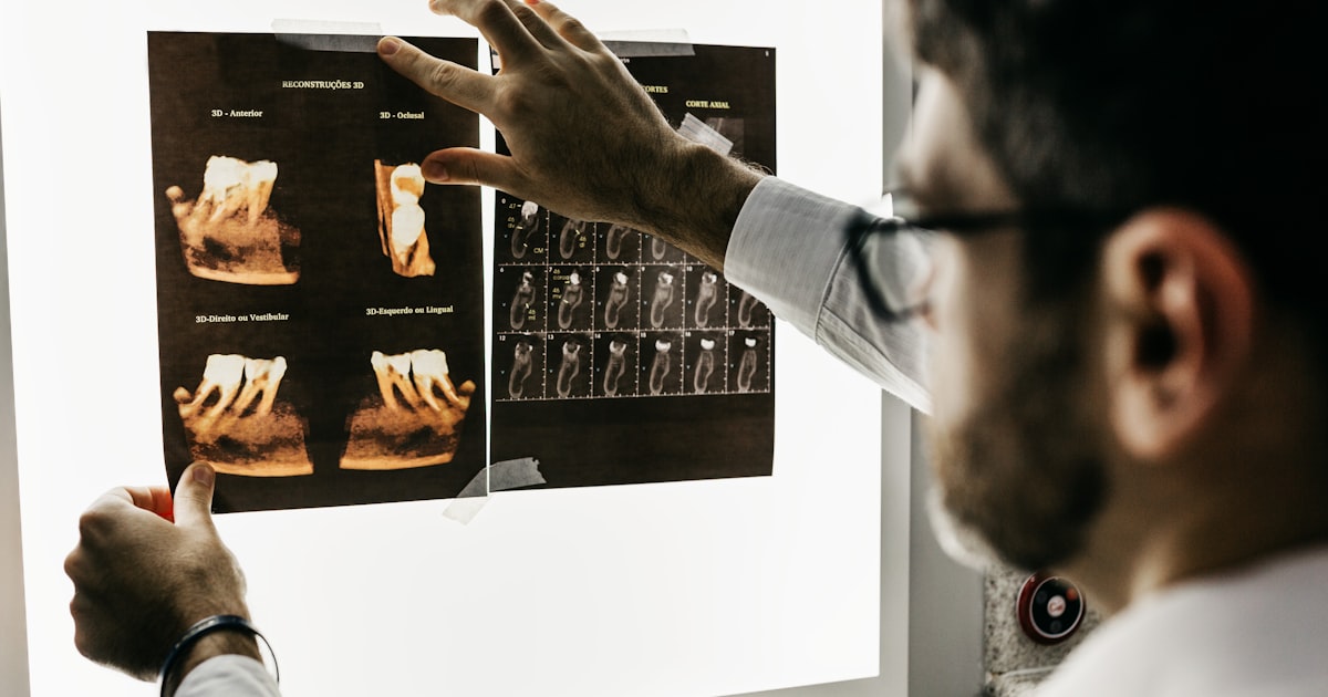 Erosão Dental Ácida: Causas, Sintomas e Como Prevenir o Desgaste